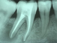 Endodonzia Chirurgica studio odontoiatrico fiumara