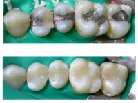 Rimozione Amalgama Dentale studio odontoiatrico fiumara