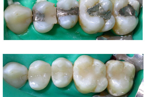 rimozione amalgama dentale studio odontoiatrico fiumara